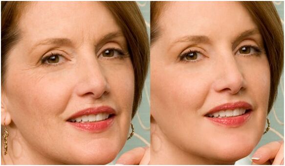 before and after rejuvenation of facial skin with plasma
