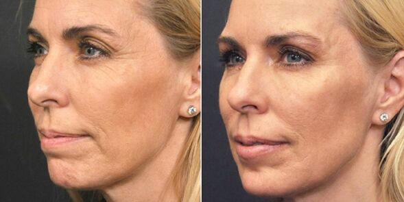 photo before and after plasma rejuvenation