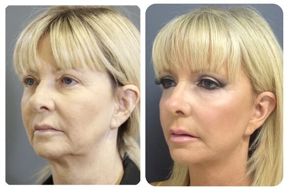 before and after skin rejuvenation with tightening photo 2