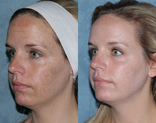 Before and after fractional resurfacing of the face