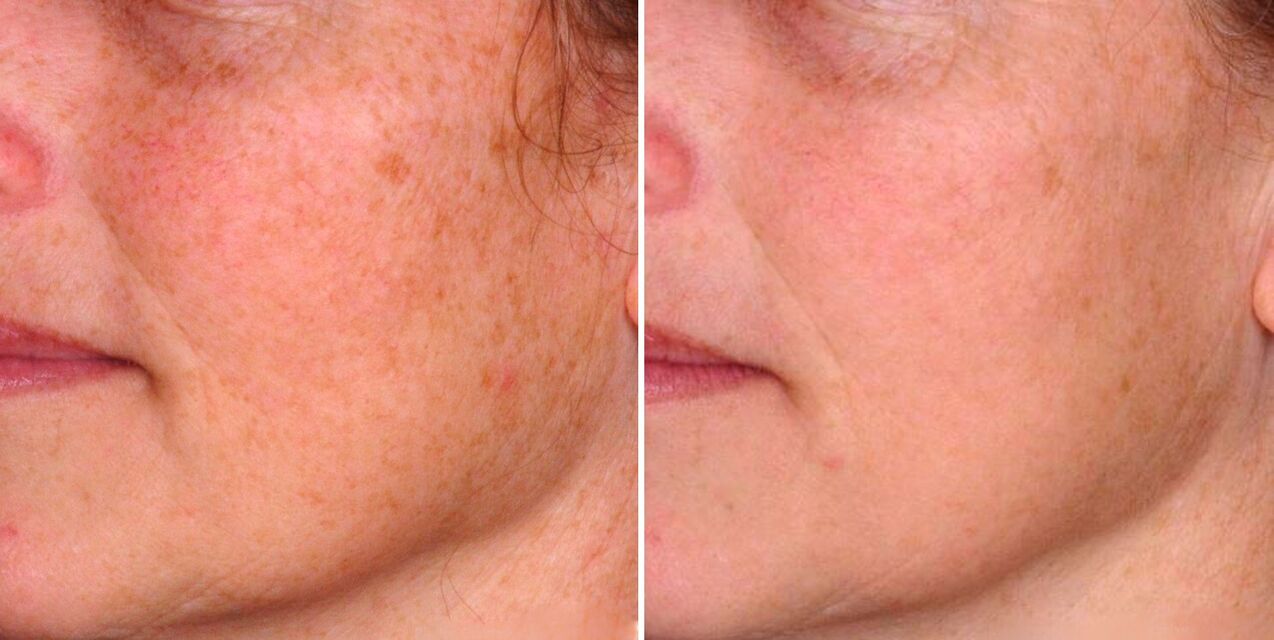 The result of fractional photothermolysis is the reduction of age spots on the facial skin. 