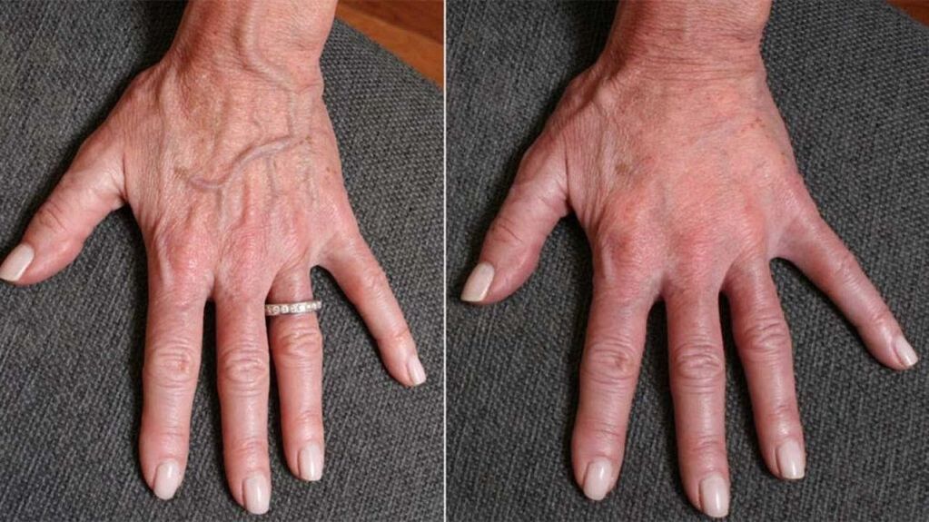 contour plastic, photo of hand renewal 1 before and after
