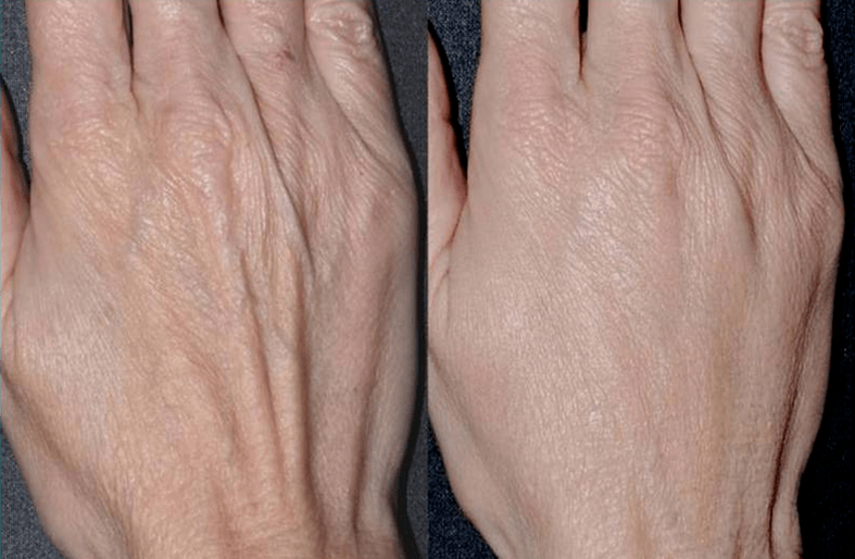 contour plastic, photo of hand renewal 2 before and after